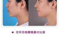 鼻子整形前后对比图,鼻子整形前后对比解析