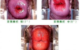 宫颈糜烂手术后症状,了解与应对之道”